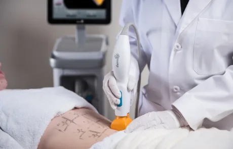 thermage treatment 3