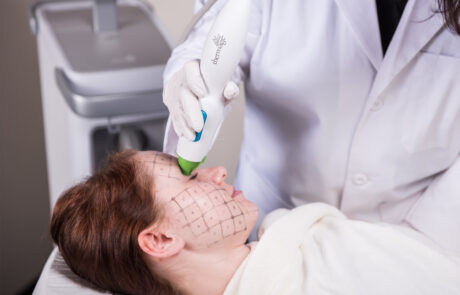 thermage treatment 2